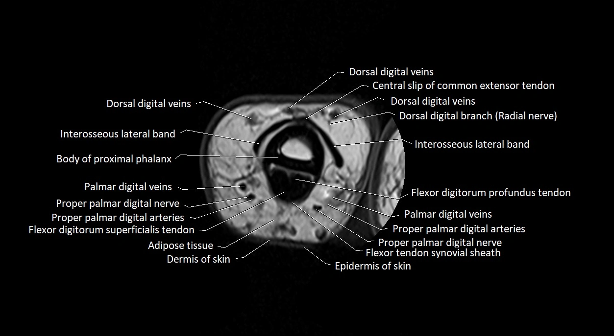 Finger anatomy axial cross sectional 3T image image 17.webp